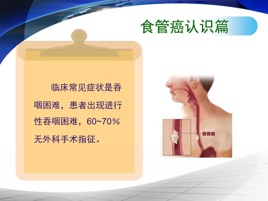 食道支架置入术相关知识ppt课件_第3页