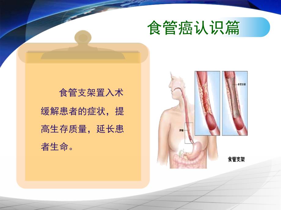 食道支架置入术相关知识ppt课件_第4页