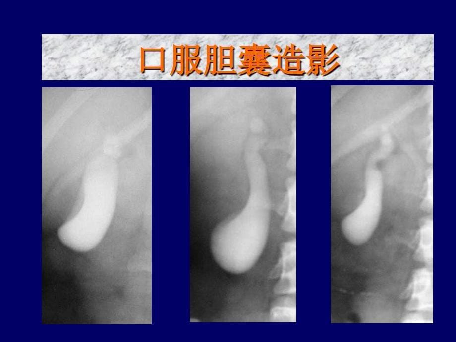 胆道常见疾病的影像学检查分析概要_第5页