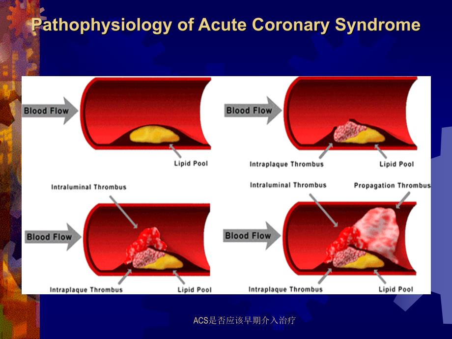 ACS是否应该早期介入治疗课件_第2页