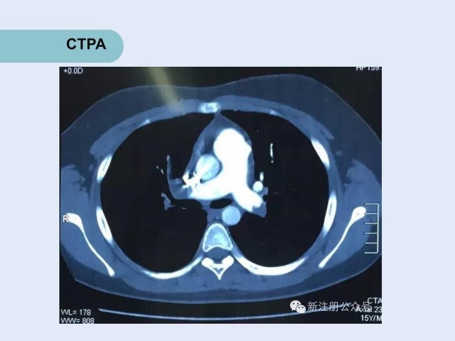 肺栓塞病例分析_第5页