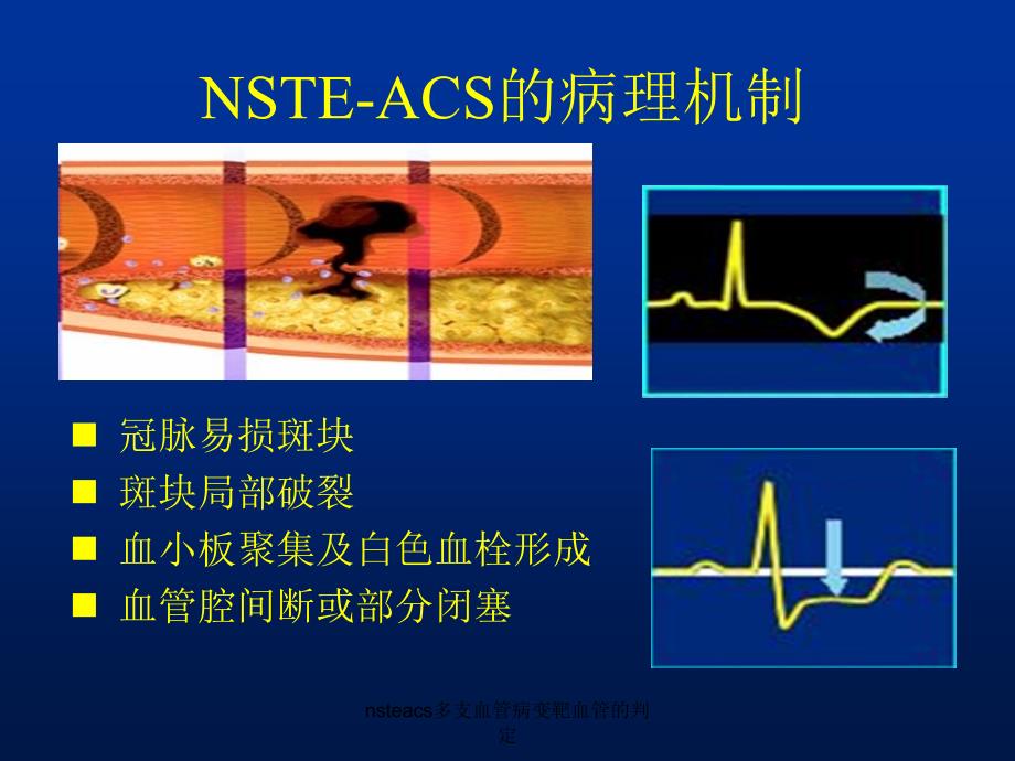 nsteacs多支血管病变靶血管的判定课件_第2页