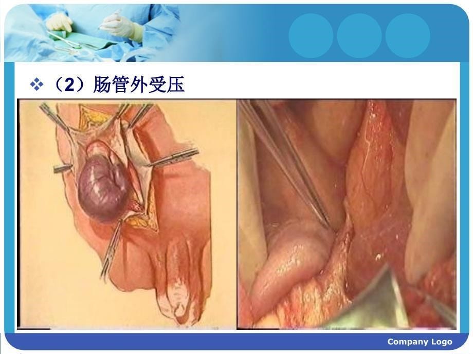 肠梗阻护理查房_第5页