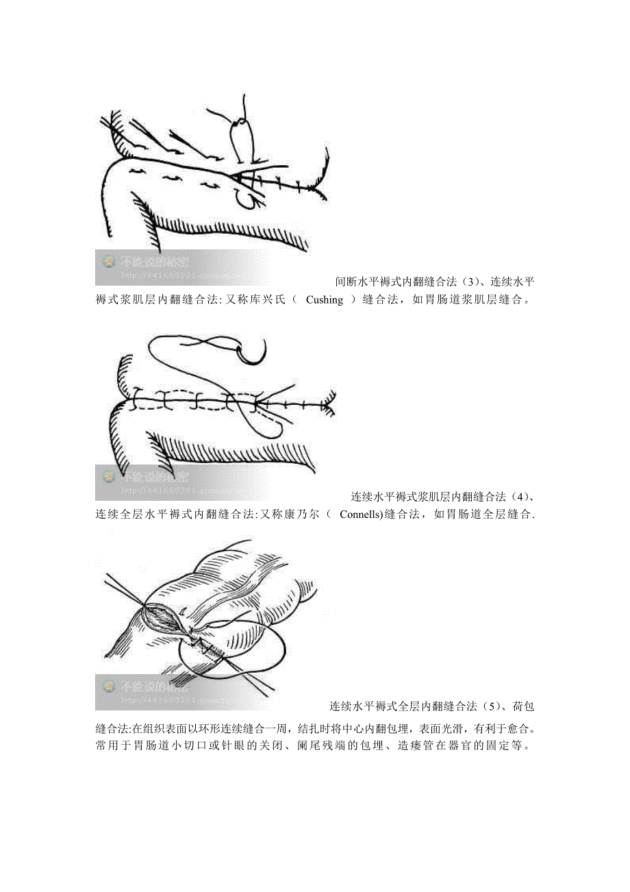外科缝合的基本方法遇(带图)_第4页