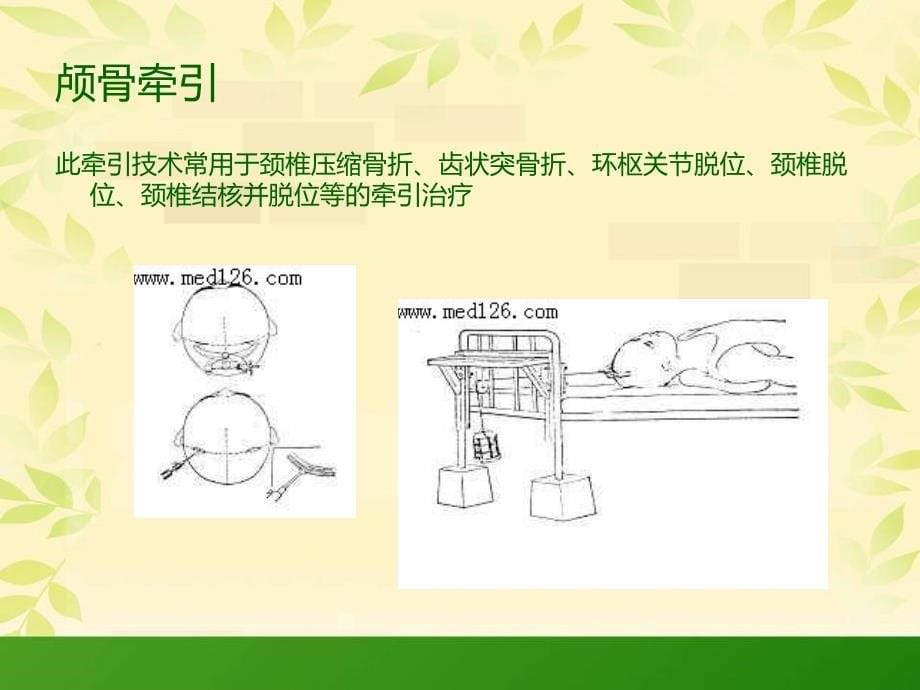 颅骨牵引护理查房_第5页