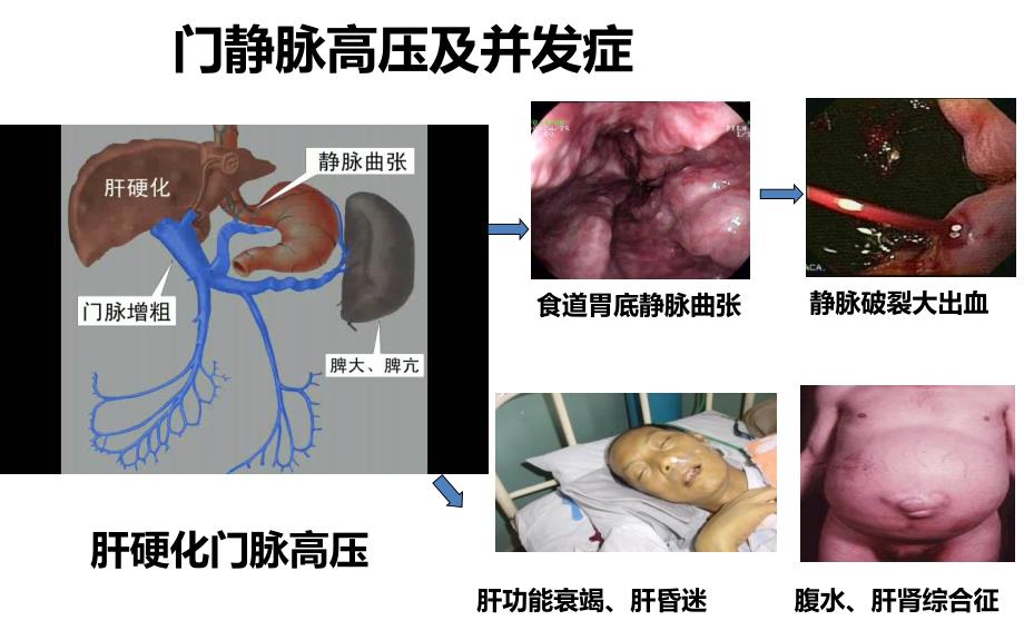 肝硬化治疗利器TIPS手术_第3页