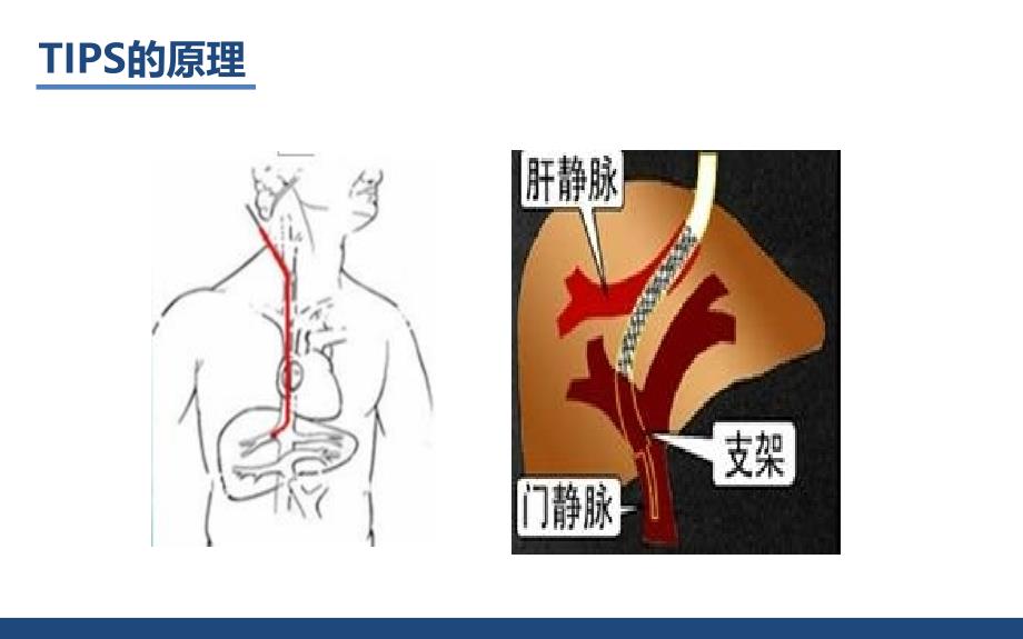 肝硬化治疗利器TIPS手术_第4页