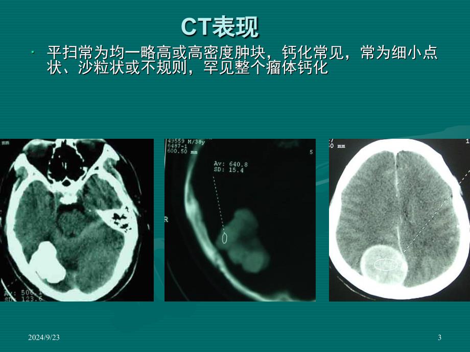 脑膜瘤ct表现课堂PPT_第3页