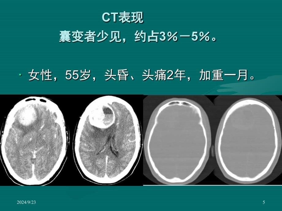 脑膜瘤ct表现课堂PPT_第5页