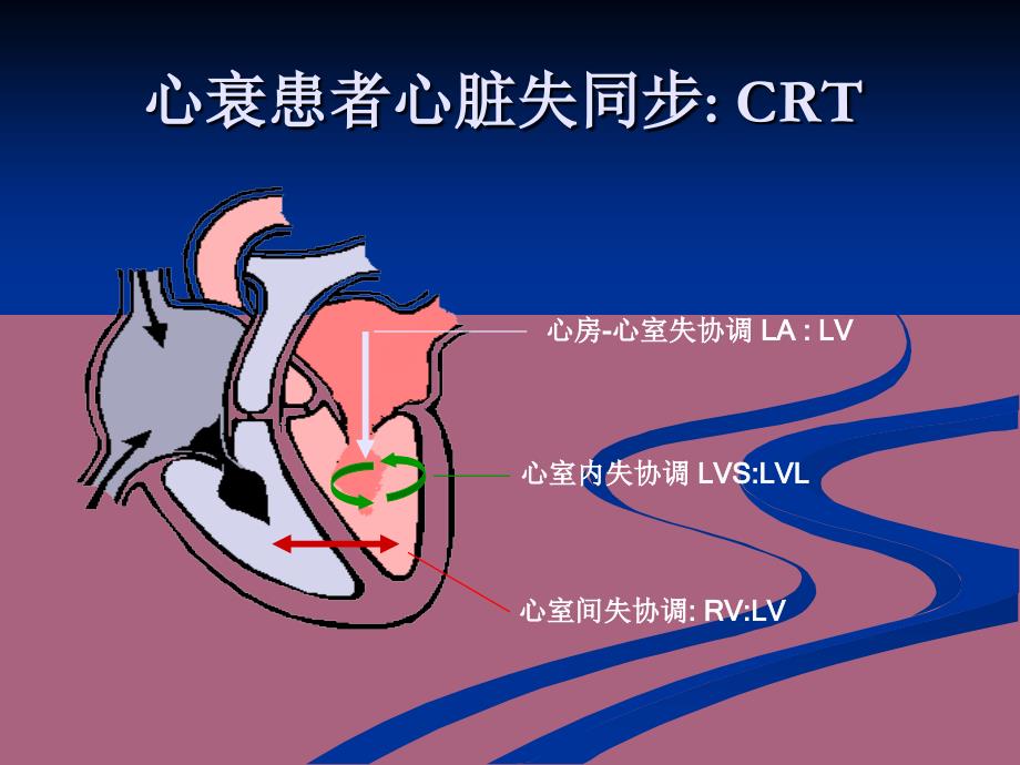 左室电极靶静脉的选择技巧ppt课件_第4页