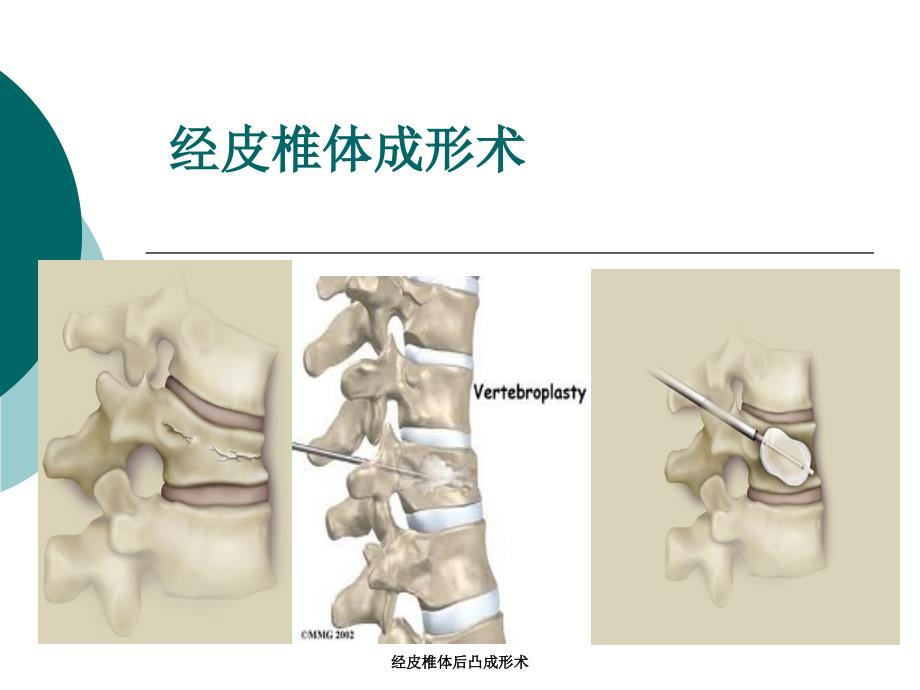 经皮椎体后凸成形术_第1页