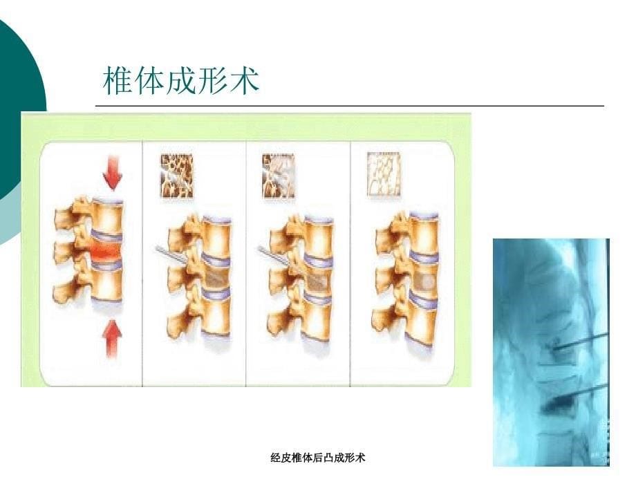 经皮椎体后凸成形术_第5页