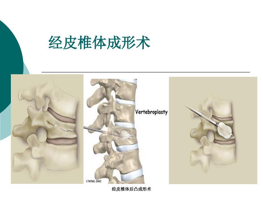 经皮椎体后凸成形术