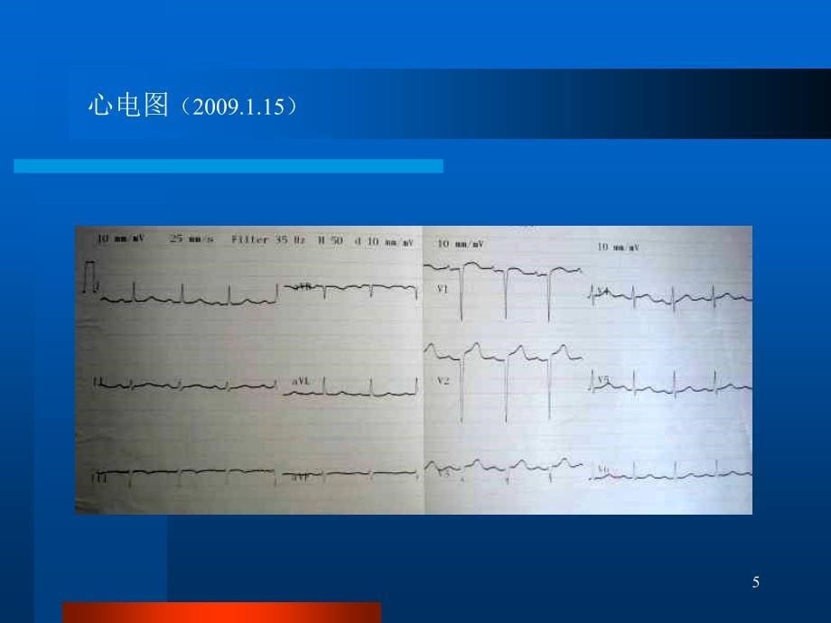 右心衰竭二例北京同仁医院心内科卢长林常连芳_第5页