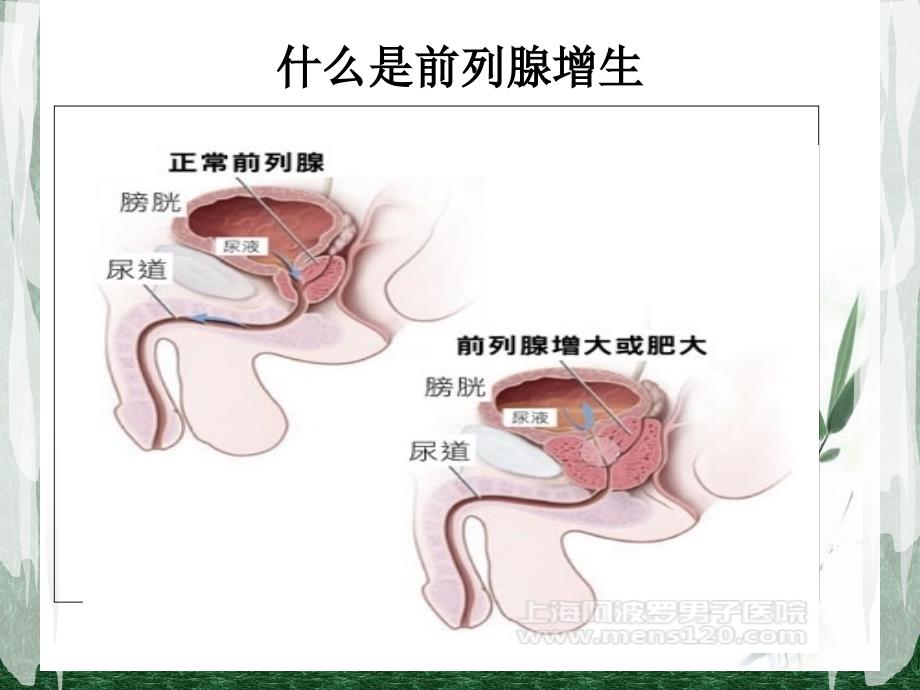 前列腺增生病人的护理课件_第4页