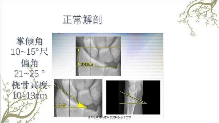 桡骨远端骨折应用锁定钢板手术方法_第3页