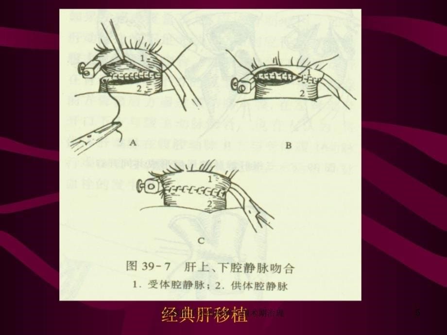 肝移植手术的麻醉与围术期治理课件_第5页