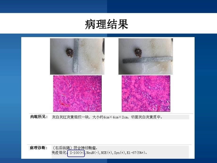 胃神经鞘瘤的诊断与鉴别诊断医学PPT课件_第5页