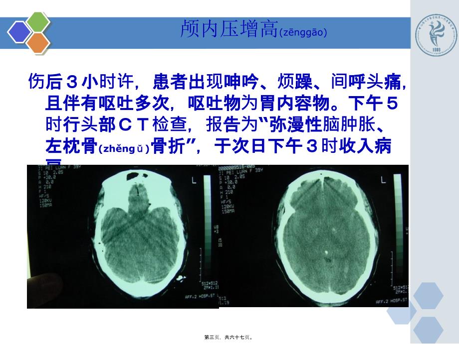 医学专题—最新新版颅内压增高病例PPT-PPT文档_第3页