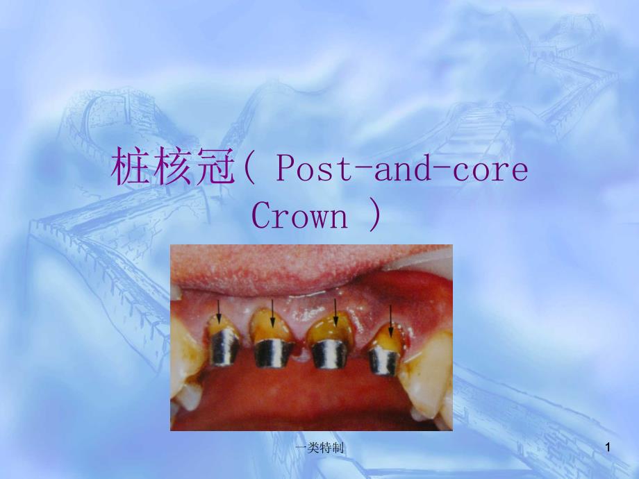 桩核冠贴面含桩核冠的组成及分类医学荟萃_第1页