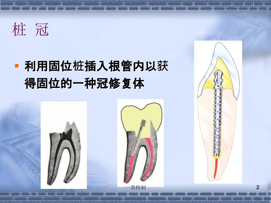 桩核冠贴面含桩核冠的组成及分类医学荟萃_第2页