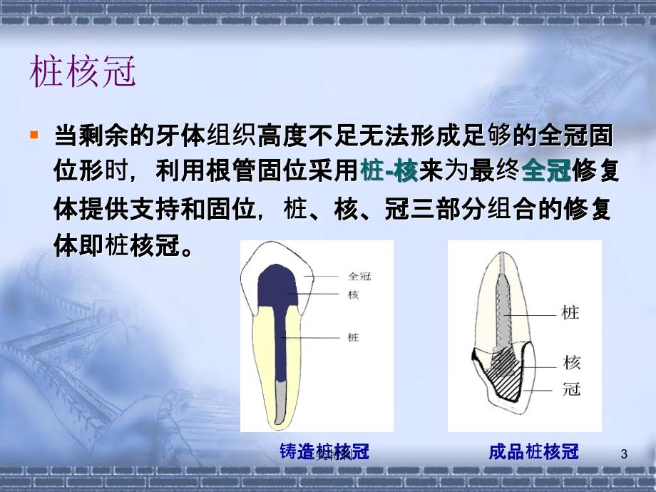 桩核冠贴面含桩核冠的组成及分类医学荟萃_第3页