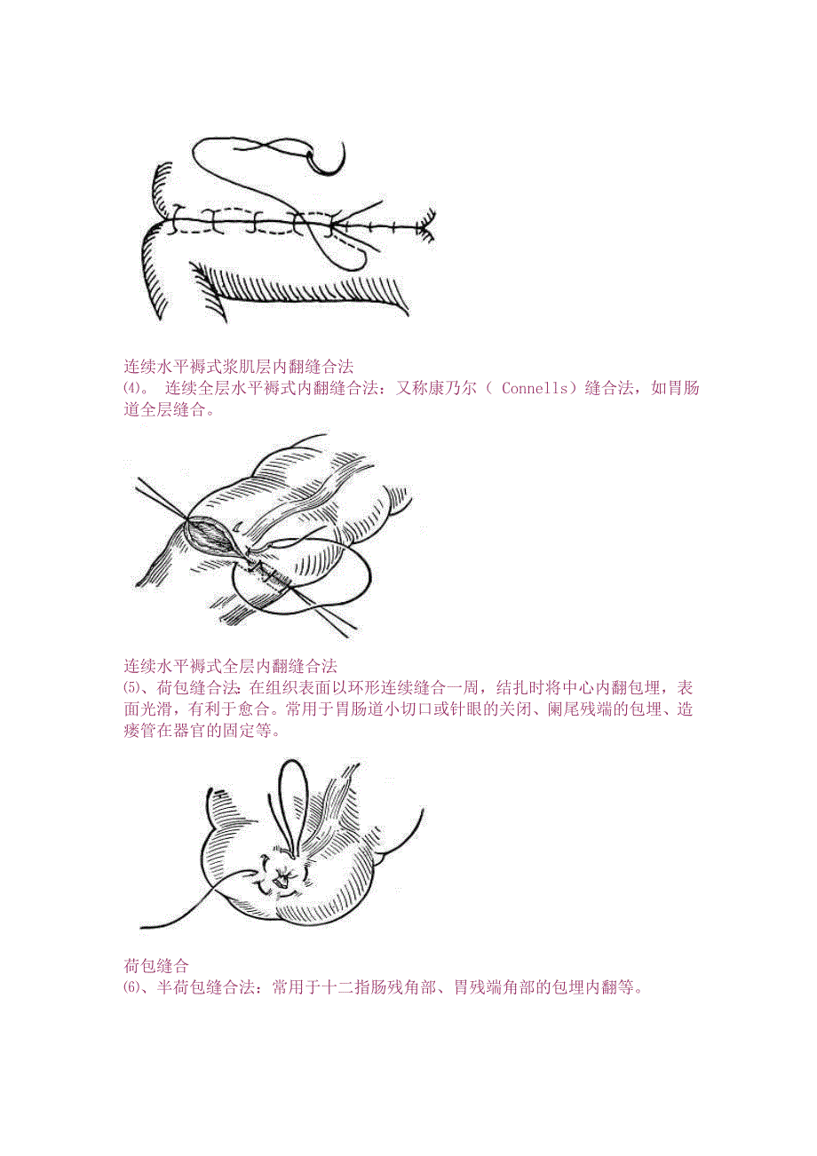 外科手术缝合法_第4页