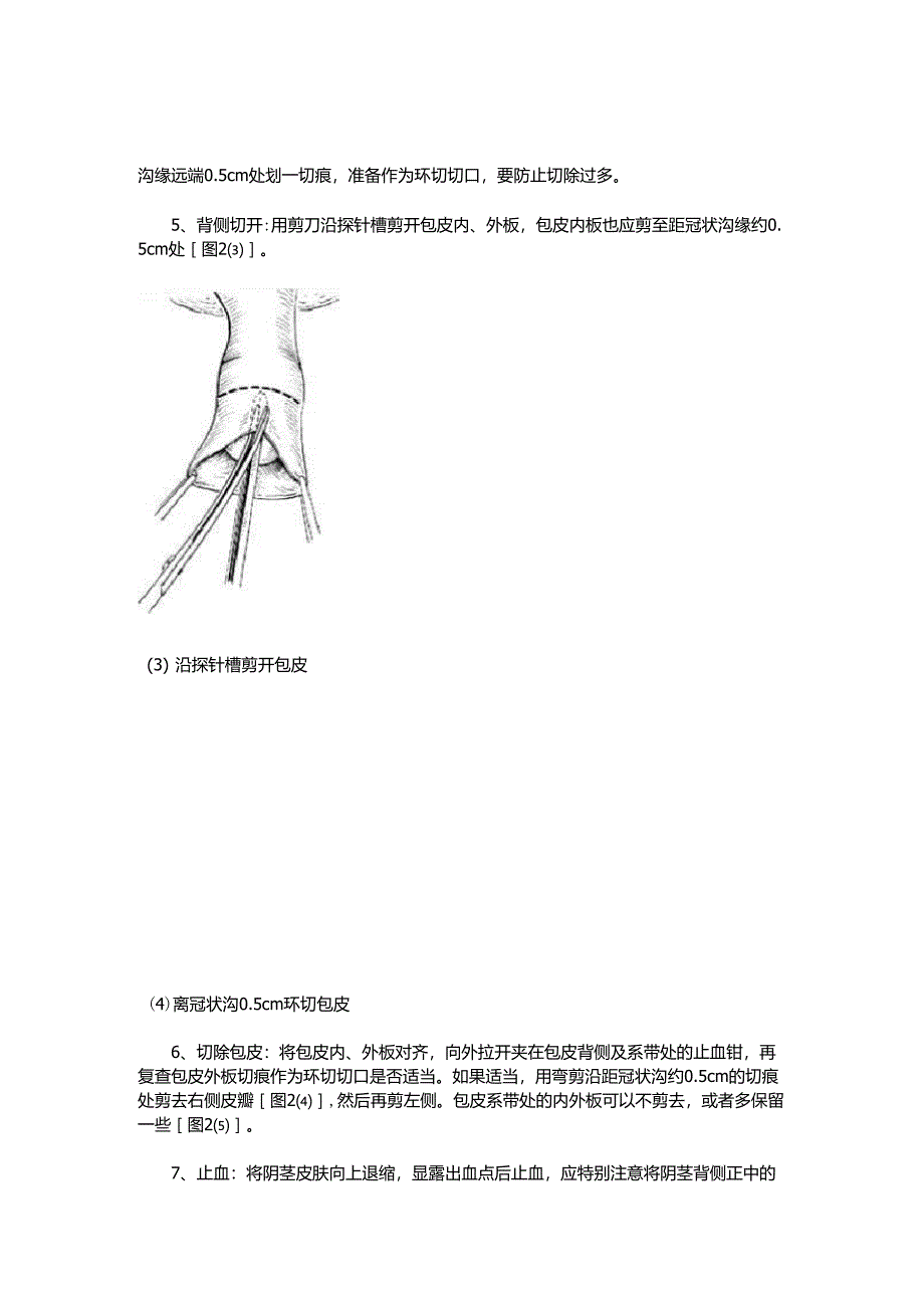 包皮环切术图解_第4页