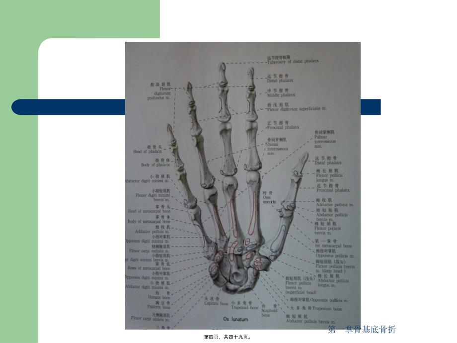 第一掌骨基底骨折课件_第4页