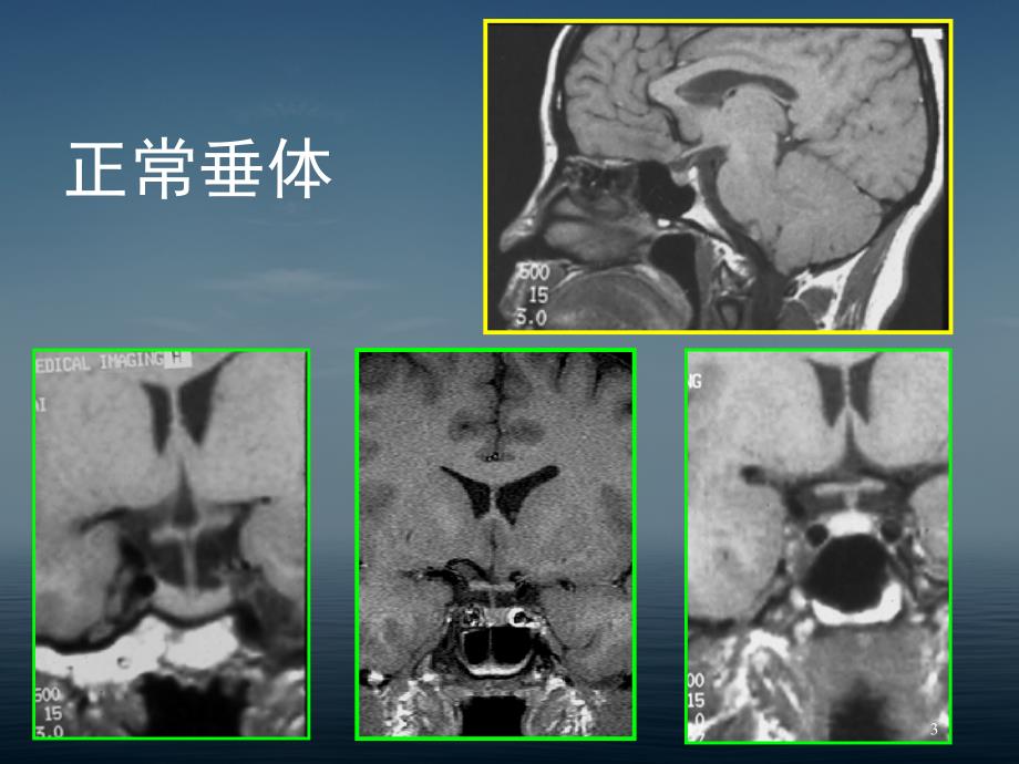 鞍区病变的CT及MRI诊断教学文案_第3页