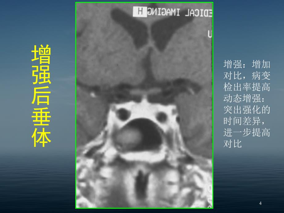 鞍区病变的CT及MRI诊断教学文案_第4页