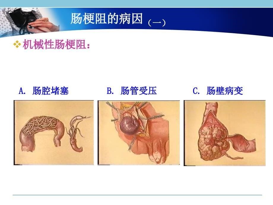 《基础医学肠梗阻》PPT课件_第5页