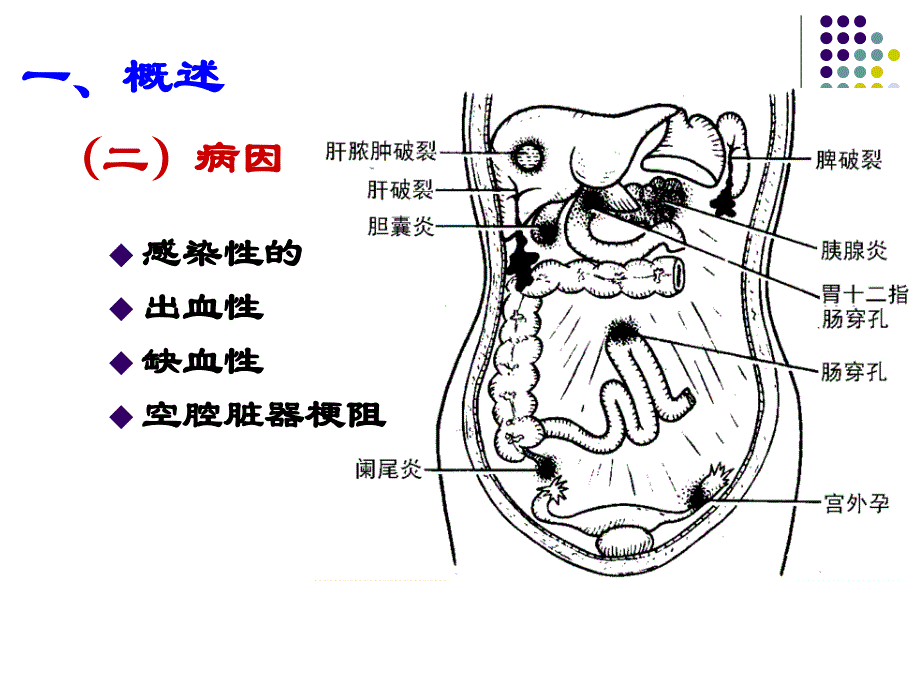 《外科护理学急腹症》PPT课件_第4页