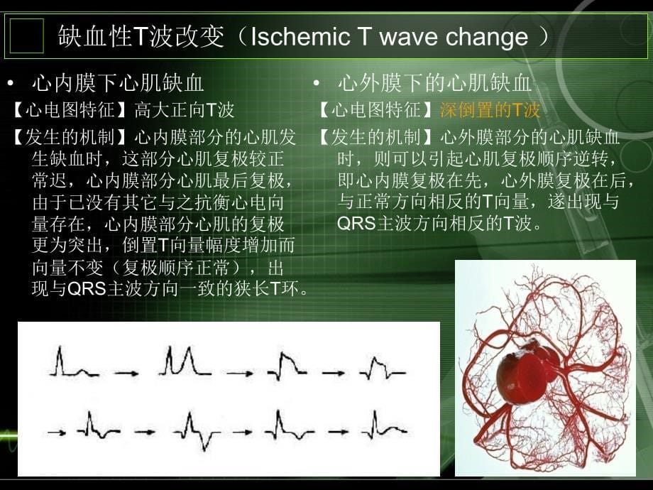 T波倒置的认识与诊断(金华心血管年会)_第5页