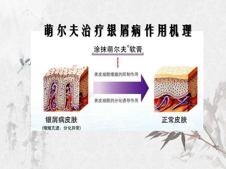 他卡西醇在银屑病治疗中的临床应用_第5页