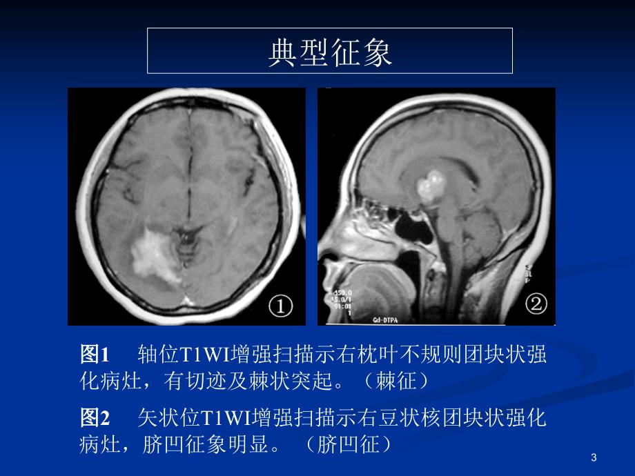 脑部原发性淋巴瘤的MRI诊断课堂PPT_第3页