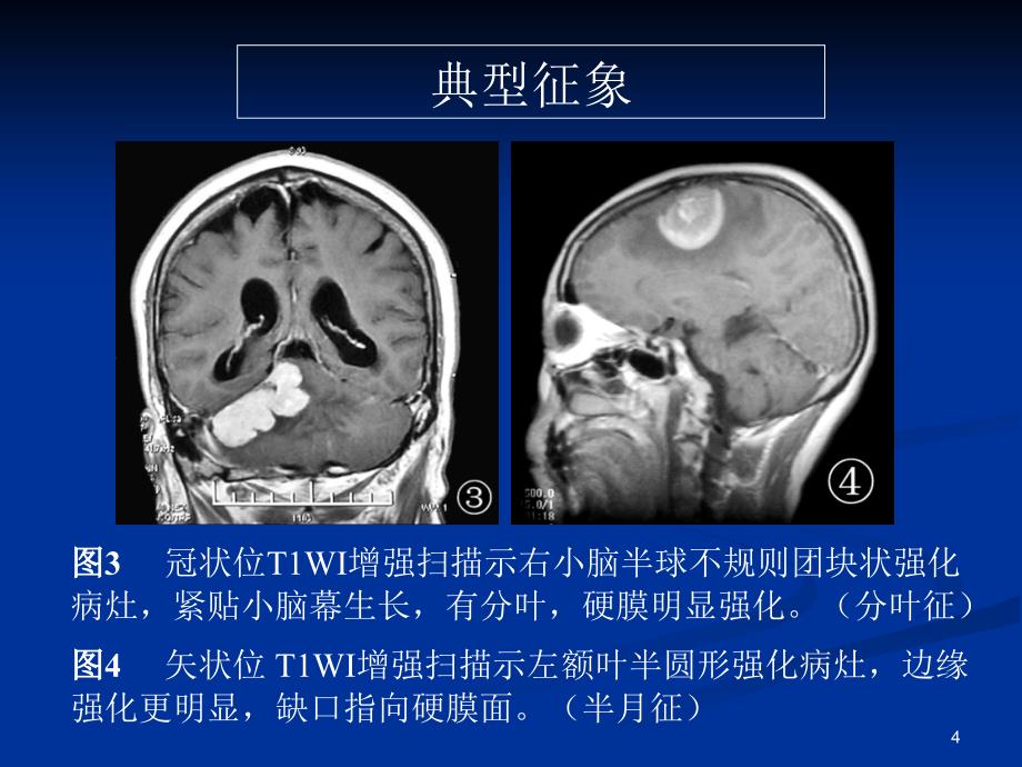 脑部原发性淋巴瘤的MRI诊断课堂PPT_第4页