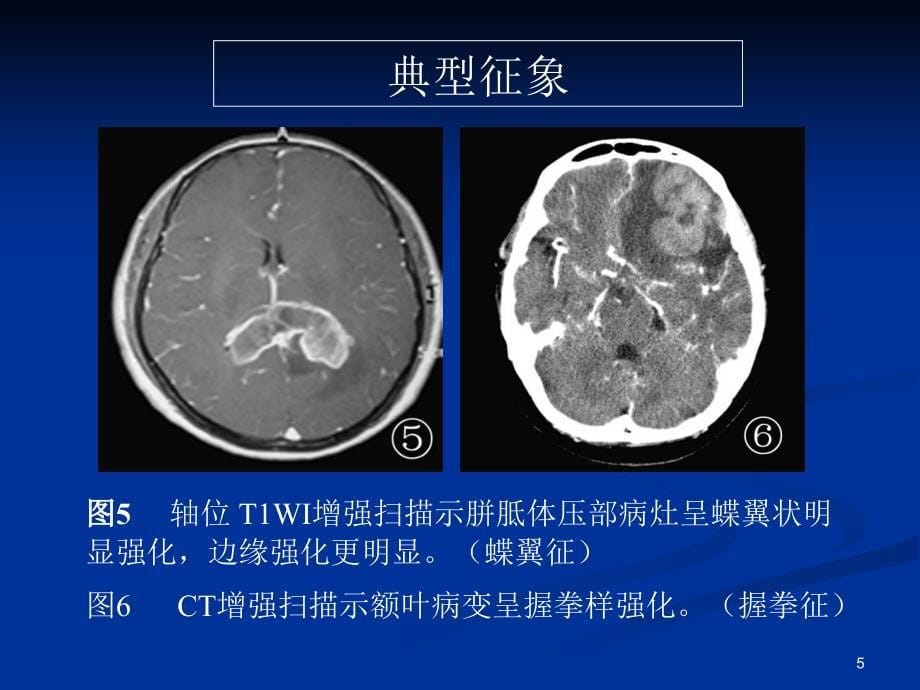 脑部原发性淋巴瘤的MRI诊断课堂PPT_第5页