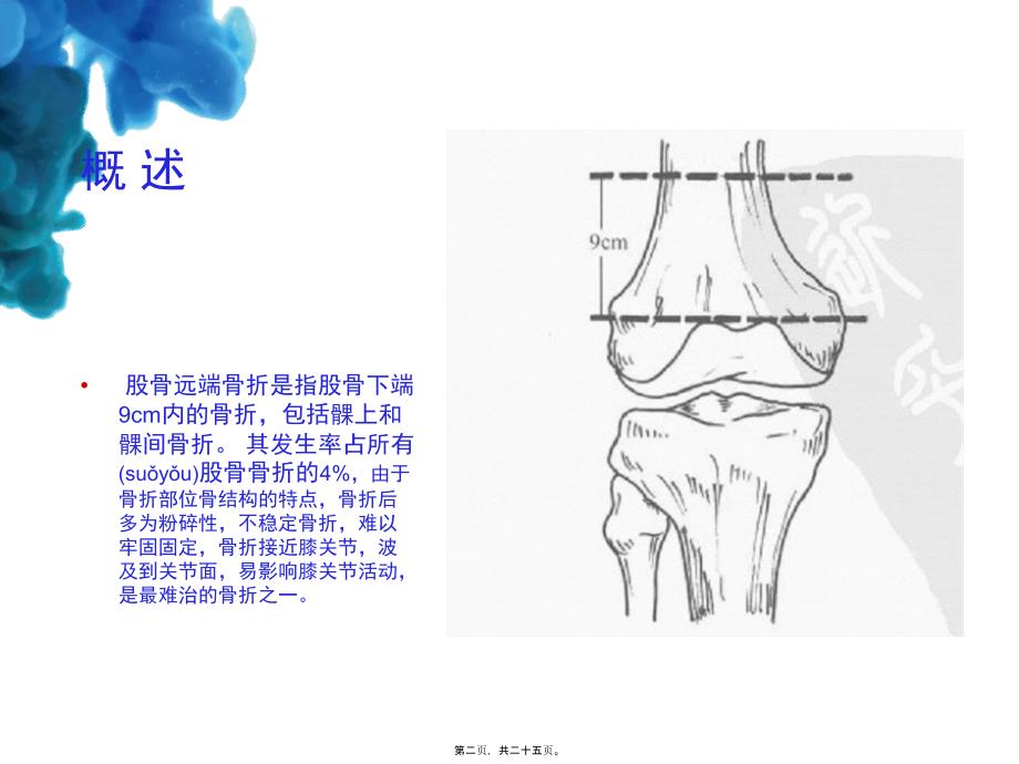 医学专题—股骨远端骨折11110832_第2页