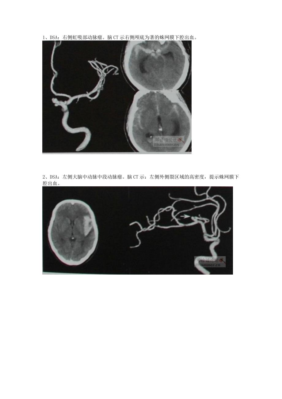 不同部位所致蛛网膜下腔出血的头颅CT表现_第1页