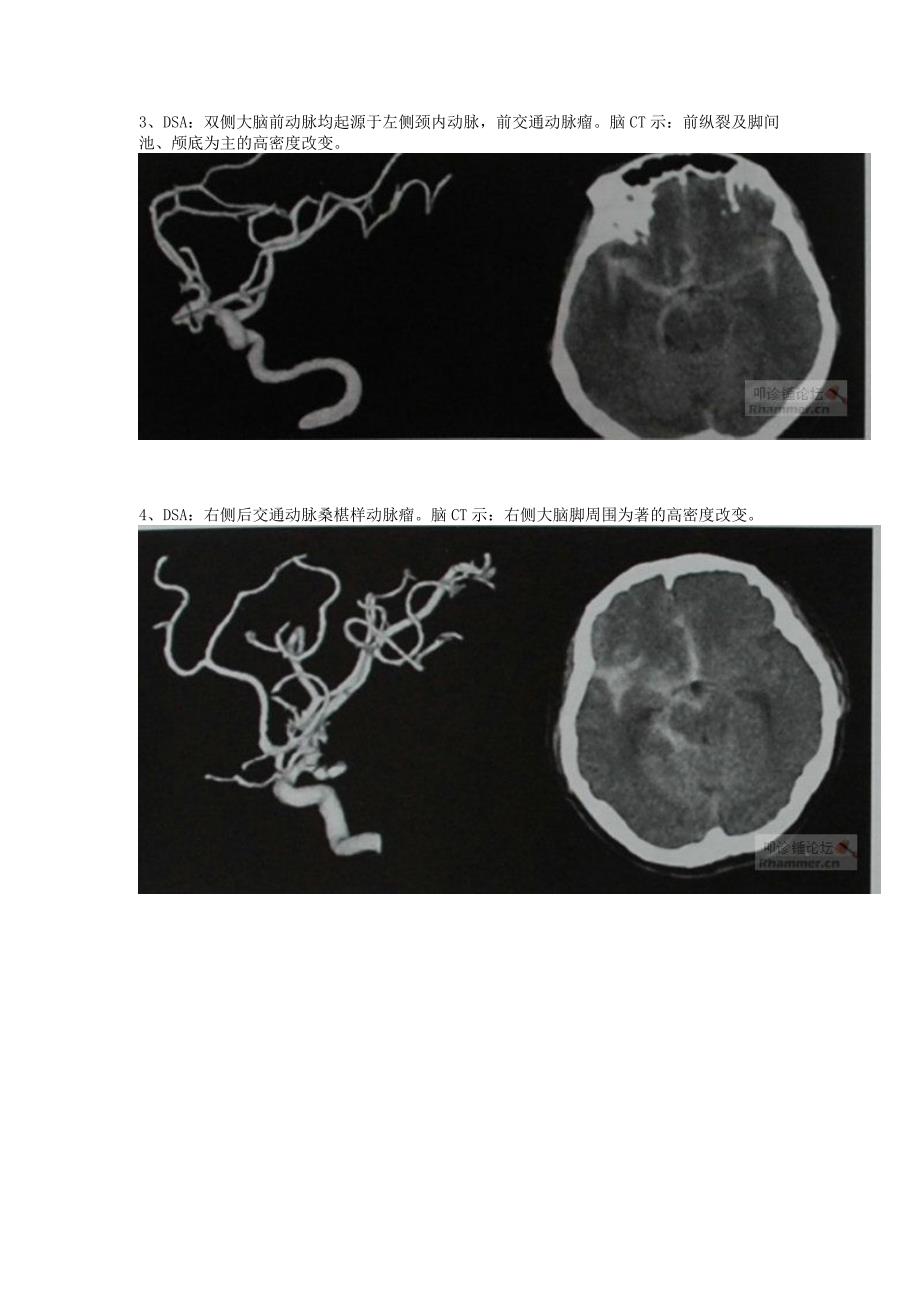 不同部位所致蛛网膜下腔出血的头颅CT表现_第2页