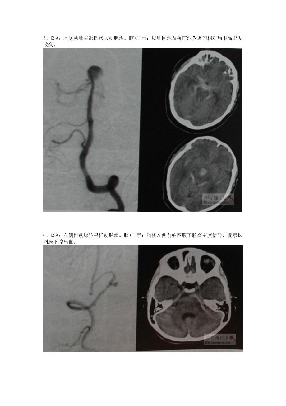 不同部位所致蛛网膜下腔出血的头颅CT表现_第3页