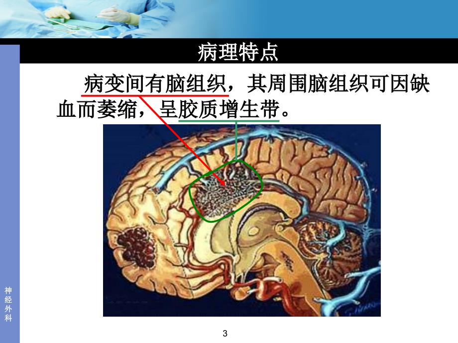 动静脉畸形_第3页