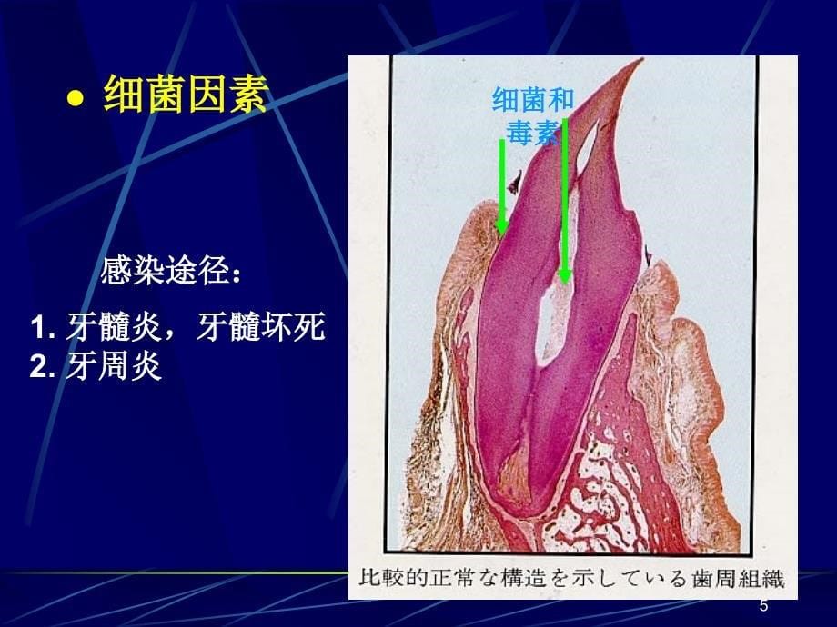 根尖周炎课件PPT课件_第5页