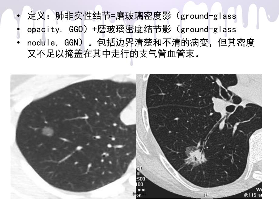 肺非实性结节解读（内容详析）_第2页