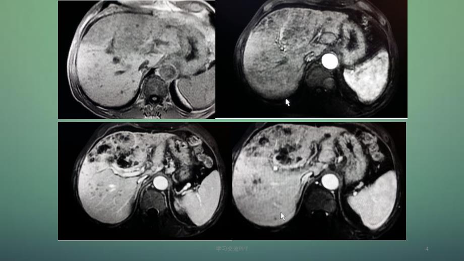 肝内胆管细胞癌医学ppt课件_第4页