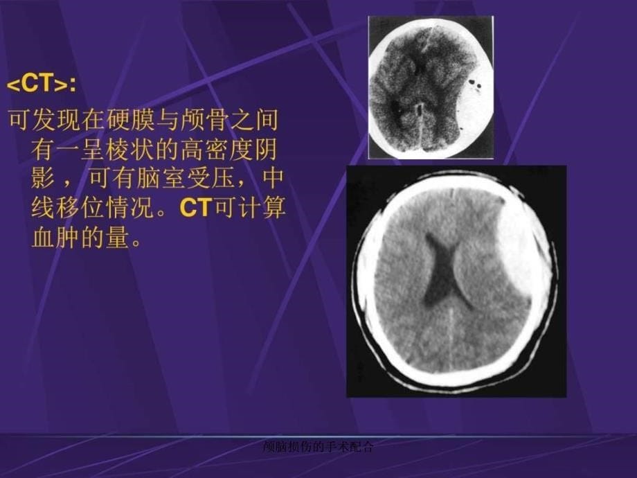 颅脑损伤的手术配合课件_第5页