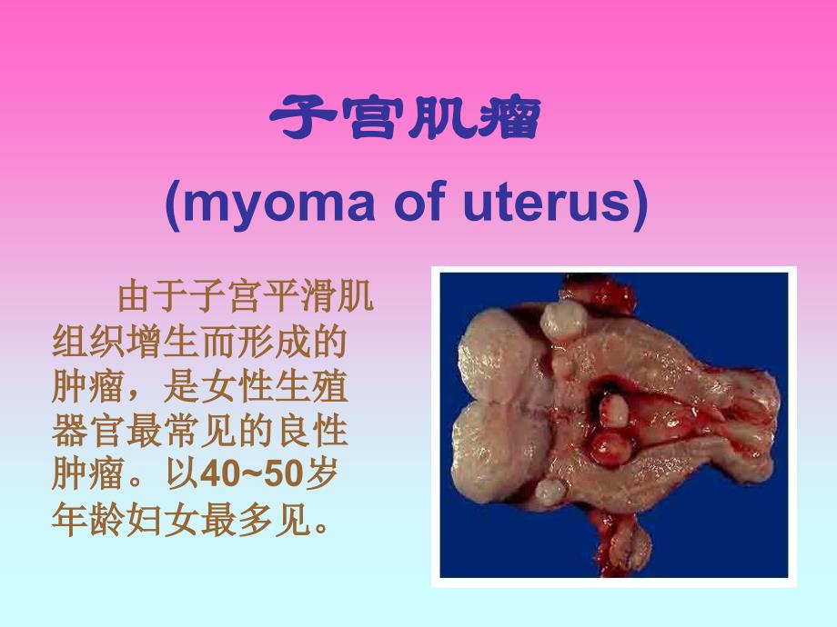 女性生殖系统肿瘤病人的护理_第3页