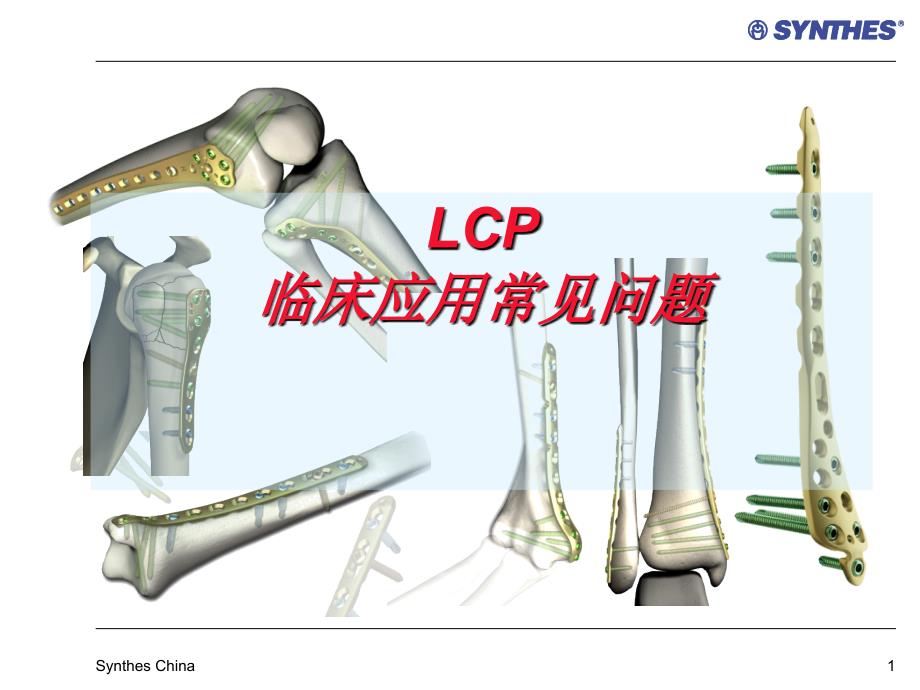 锁定内固定系统临床应用常见问题LCP-Questions课件.ppt_第1页