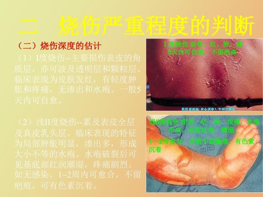 烧伤的现场急救_第5页